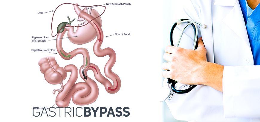 At The Center for Bariatrics in Tijuana Mexico, gastric bypass surgery is widely considered to be the “gold standard” when it comes to medical weight loss procedures.