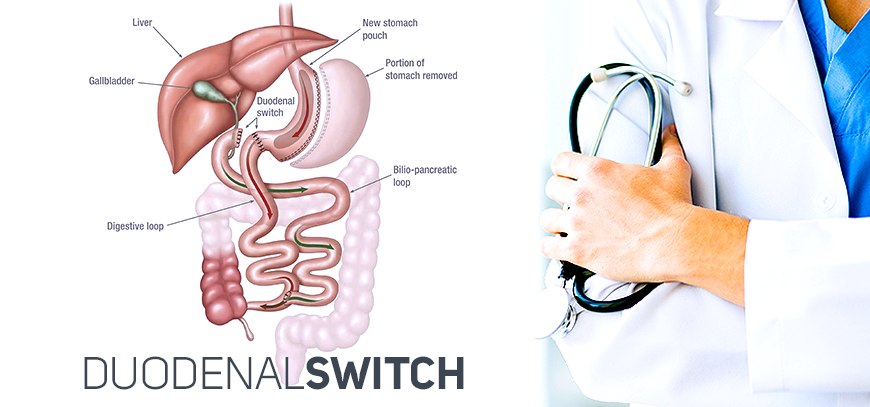 At The Center for Bariatrics, in Tijuana, Mexico you may be considering duodenal switch surgery if you have a body mass index (BMI) of 50 or greater.