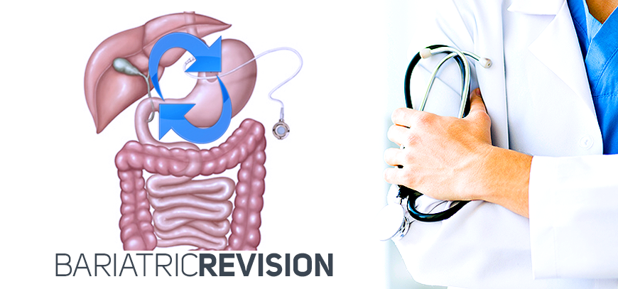 Bariatric Revision Surgery in Tijuana refers to a second weight loss surgery. Revisional options include: 1) lap band to gastric sleeve, 2) lap band to gastric bypass, 3) gastric sleeve to gastric bypass, and 4) gastric sleeve to duodenal switch.