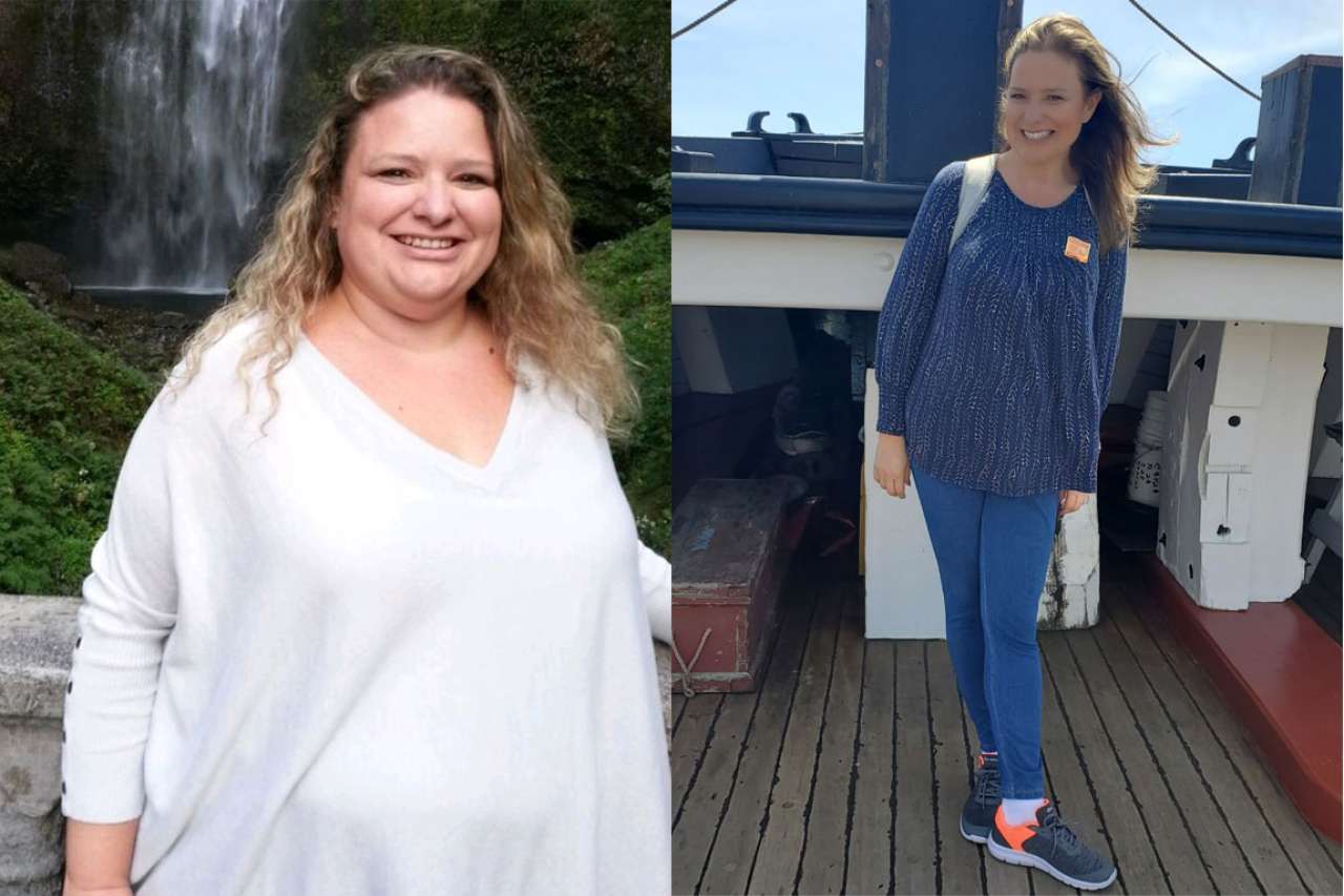 Weight Loss Surgery Before and After Photos from patients having bariatric surgery in Tijuana, Mexico.