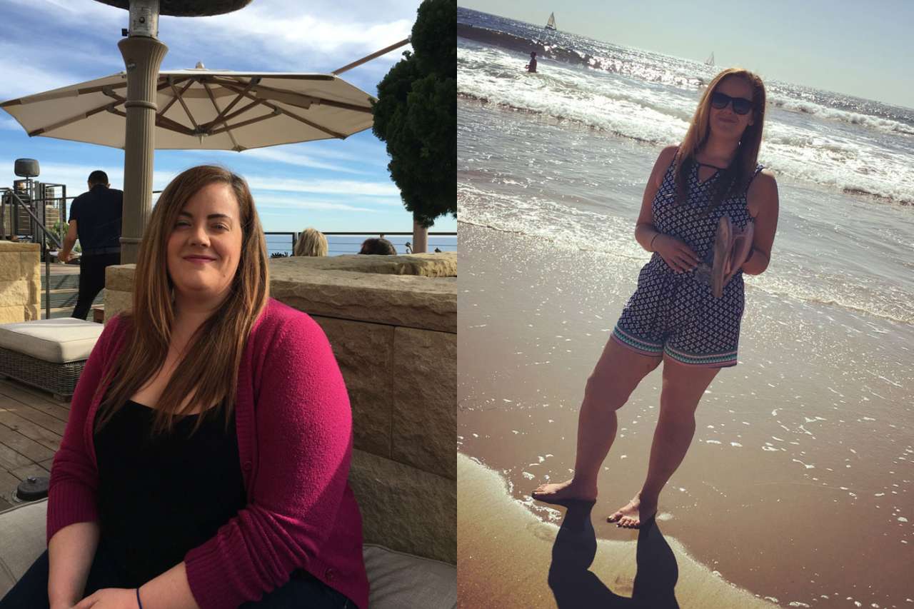 Weight Loss Surgery Before and After Photos from patients having bariatric surgery in Tijuana, Mexico.
