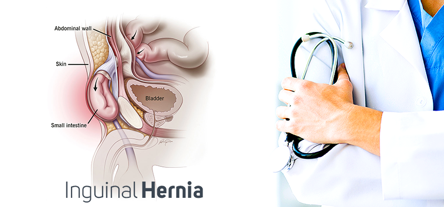 Surgery is an effective way to treat a severe inguinal hernia. At Tijuana Bariatric Surgery laparoscopic repair is the most common procedure.