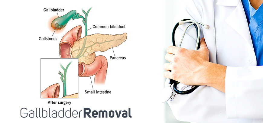 At The Center for Bariatrics, in Tijuana, Mexico, Dr. Ismael V. Bailon offers laparoscopic gallbladder removal.