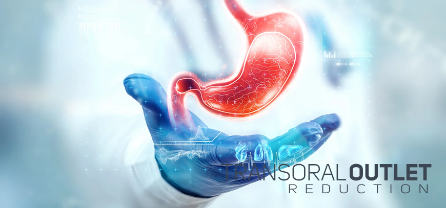 At The Center for Bariatrics, in Tijuana, Mexico, if you regain weight after gastric bypass surgery, transoral outlet reduction (TORe) can help you restart your weight loss program.